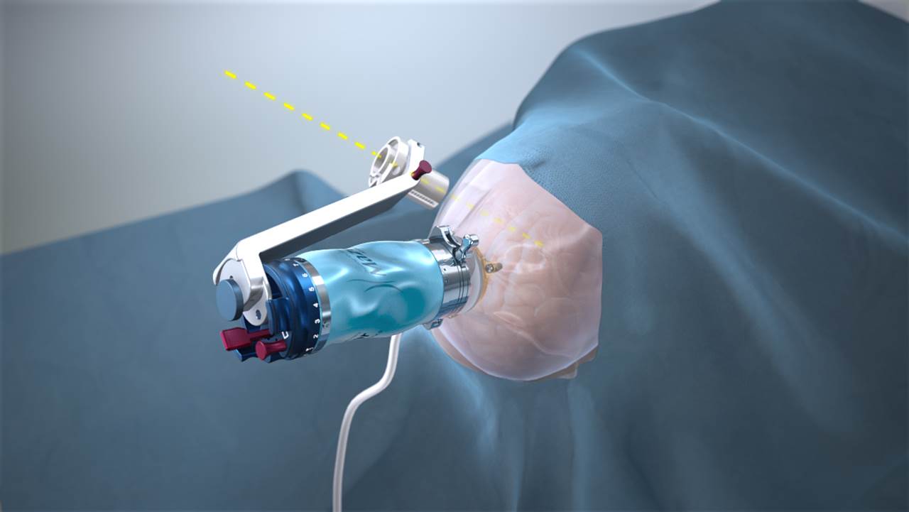 robot assisted brain surgery